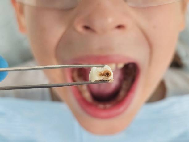 Best Emergency Wisdom Teeth Removal in Inesville, GA